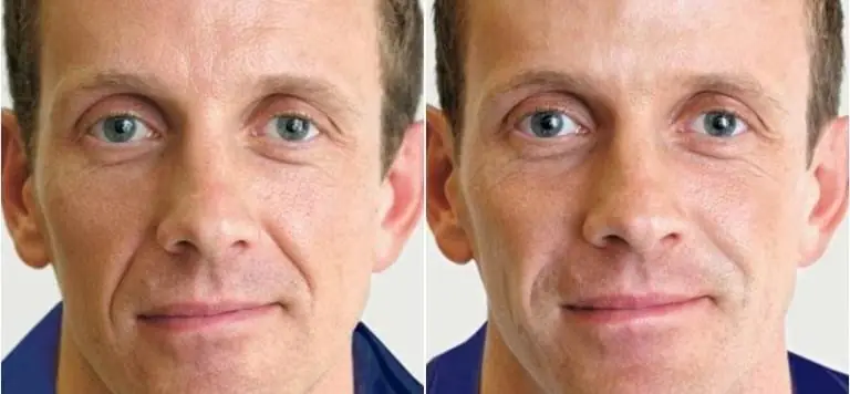 Nip And Tuck Procedure