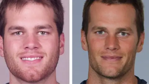 Did Tom Brady Get Plastic Surgery?