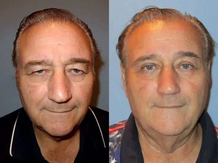 Nip And Tuck Procedure