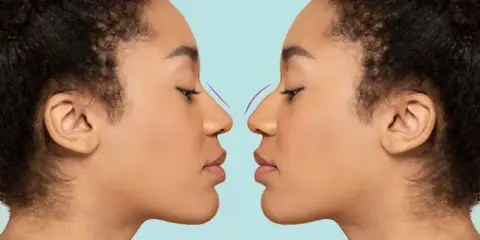 How Long Does a Non Surgical Nose Job Last?